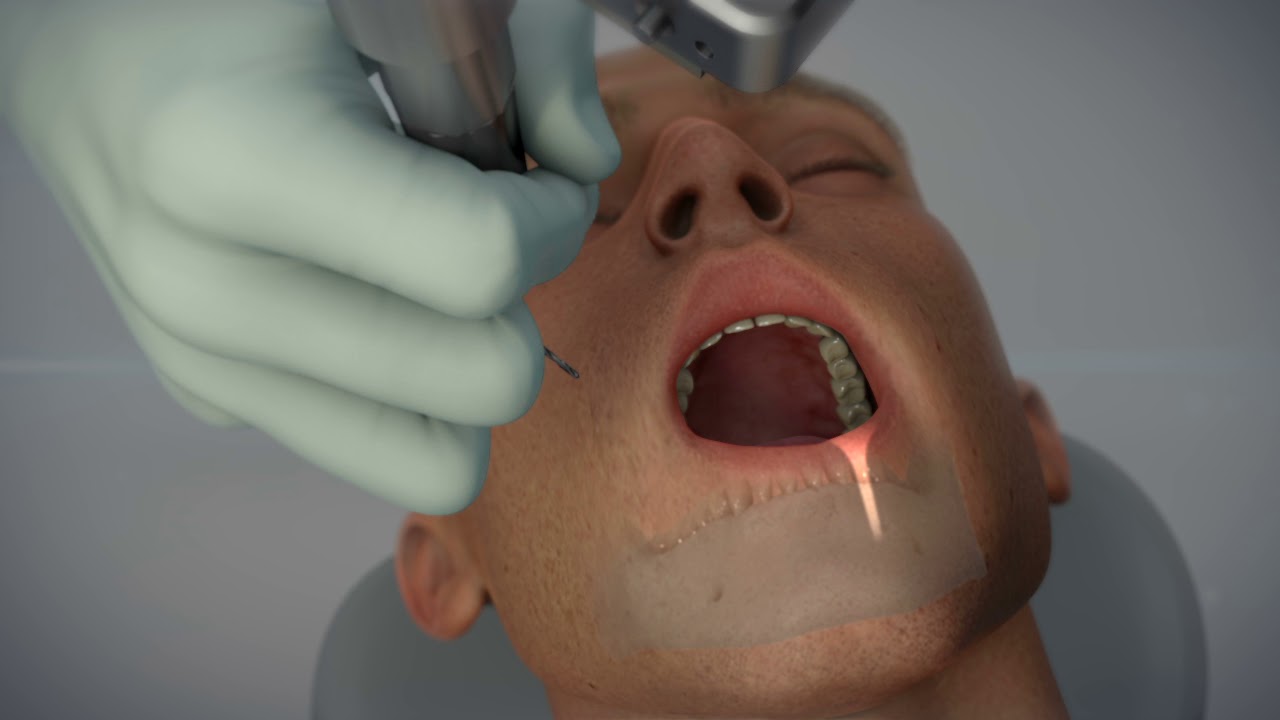 guided implant surgery