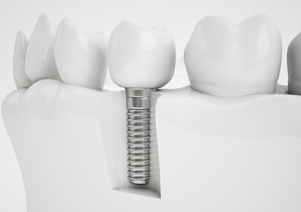 The Dental Implants Rundown