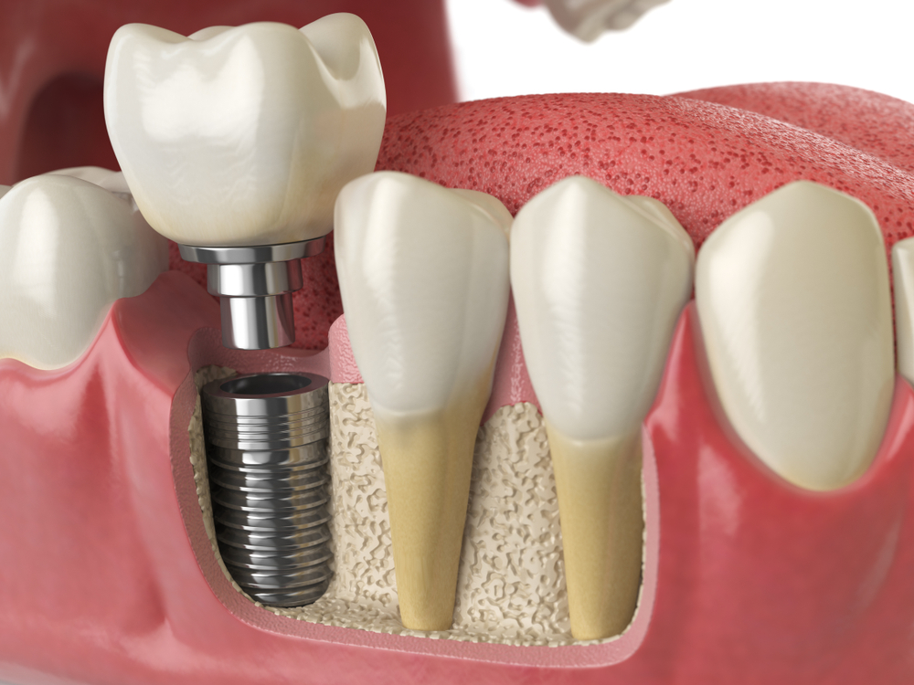 How to Create a Strong Foundation for Dental Implants